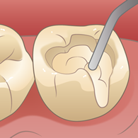 CR充填（コンポジットレジン充填）