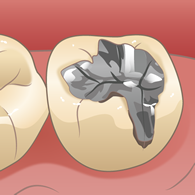 銀歯の詰め物