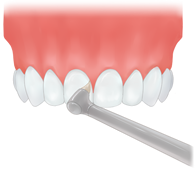STEP1 歯と歯の間の清掃をします。